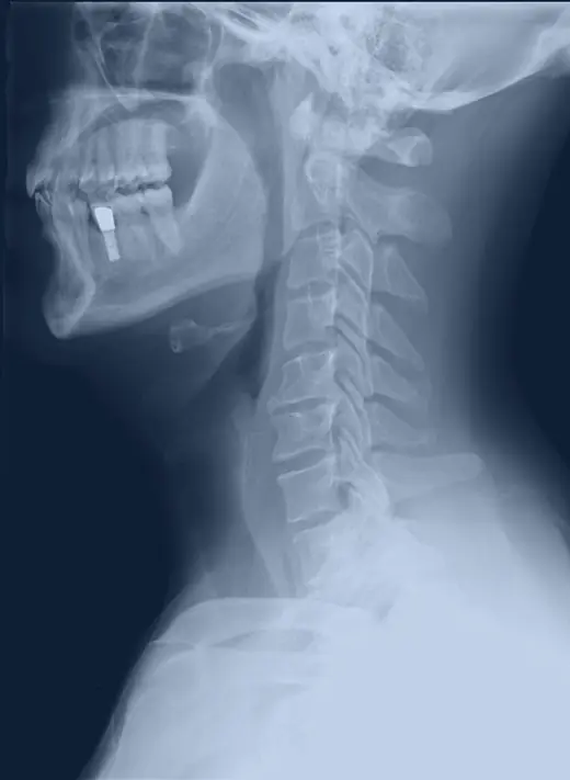 Radiografia da coluna cervical