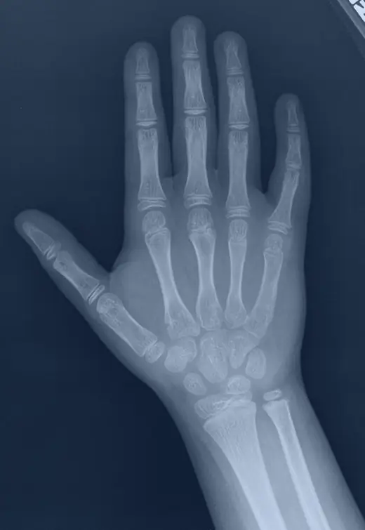 Radiografia da mão