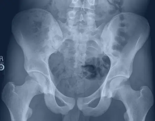 Radiografia da pelve