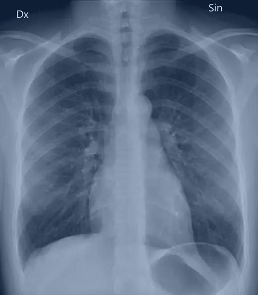 Radiografia de tórax